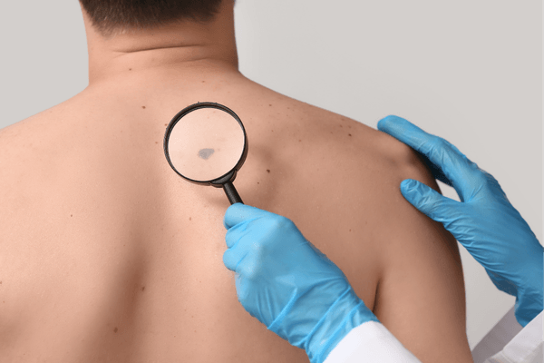 Manchas na pele o que pode ser e quando procurar um dermatologista (1)